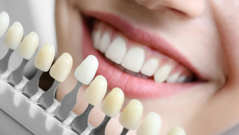 Bělení zubů – barva zubu